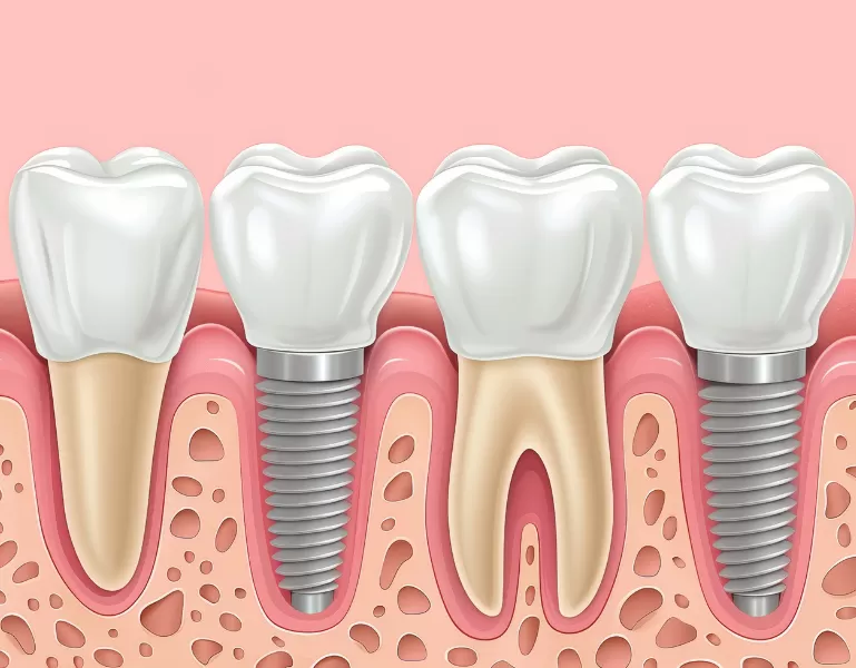 Com'è fatto un impianto dentale? 